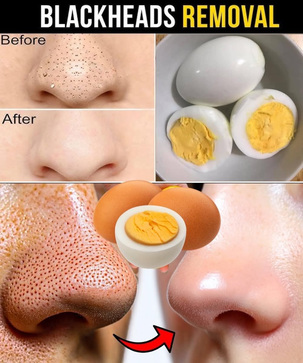 Say Goodbye to Blackheads with Just One Egg 626715573 897961082636248 3549154987127419420 n